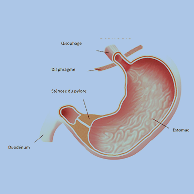 Il s’agit d’un épaississement anormal du muscle pylorique, situé à la sortie de l’estomac, réalisant un obstacle à l’évacuation gastrique. 
Cette affection touche essentiellement le bébé garçon vers l’âge de 3 semaines de vie. 
Elle se manifeste par des vomissements tardifs après le biberon. Rapidement, le bébé perd du poids se déshydrate. L’échographie permet le diagnostic. Le traitement est exclusivement chirurgical, après perfusion de réhydratation du bébé. 